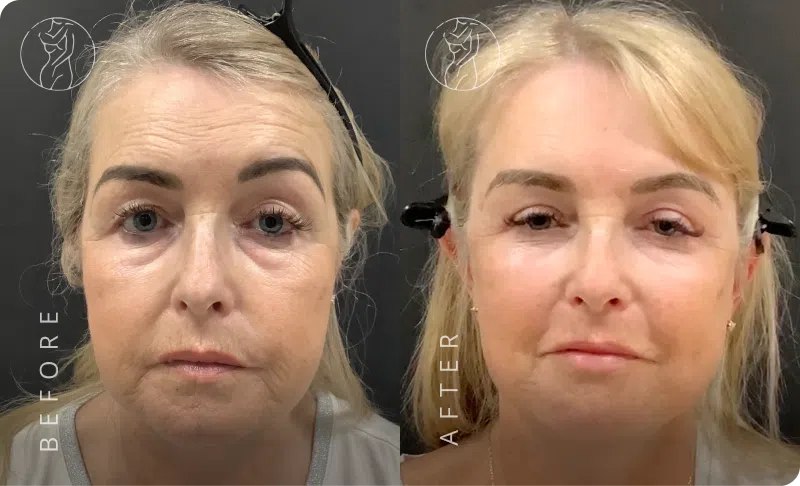 Deep Plane Facelift Result 1