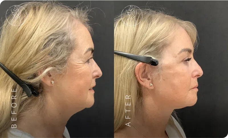 Deep Plane Facelift Result 2