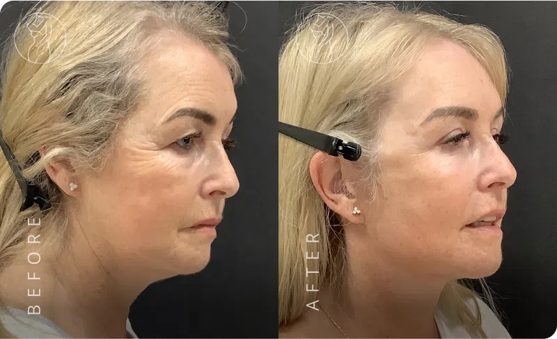 Deep Plane Facelift Result 4