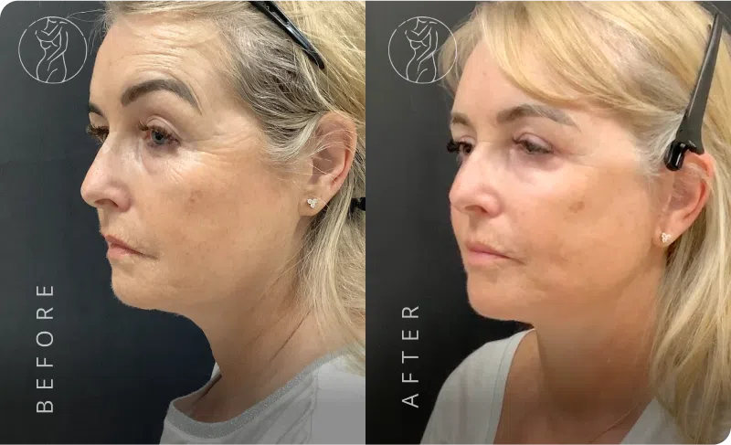 Deep Plane Facelift Result 5