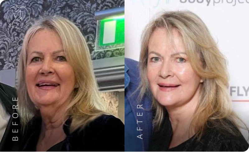 Deep Plane Facelift Result 6